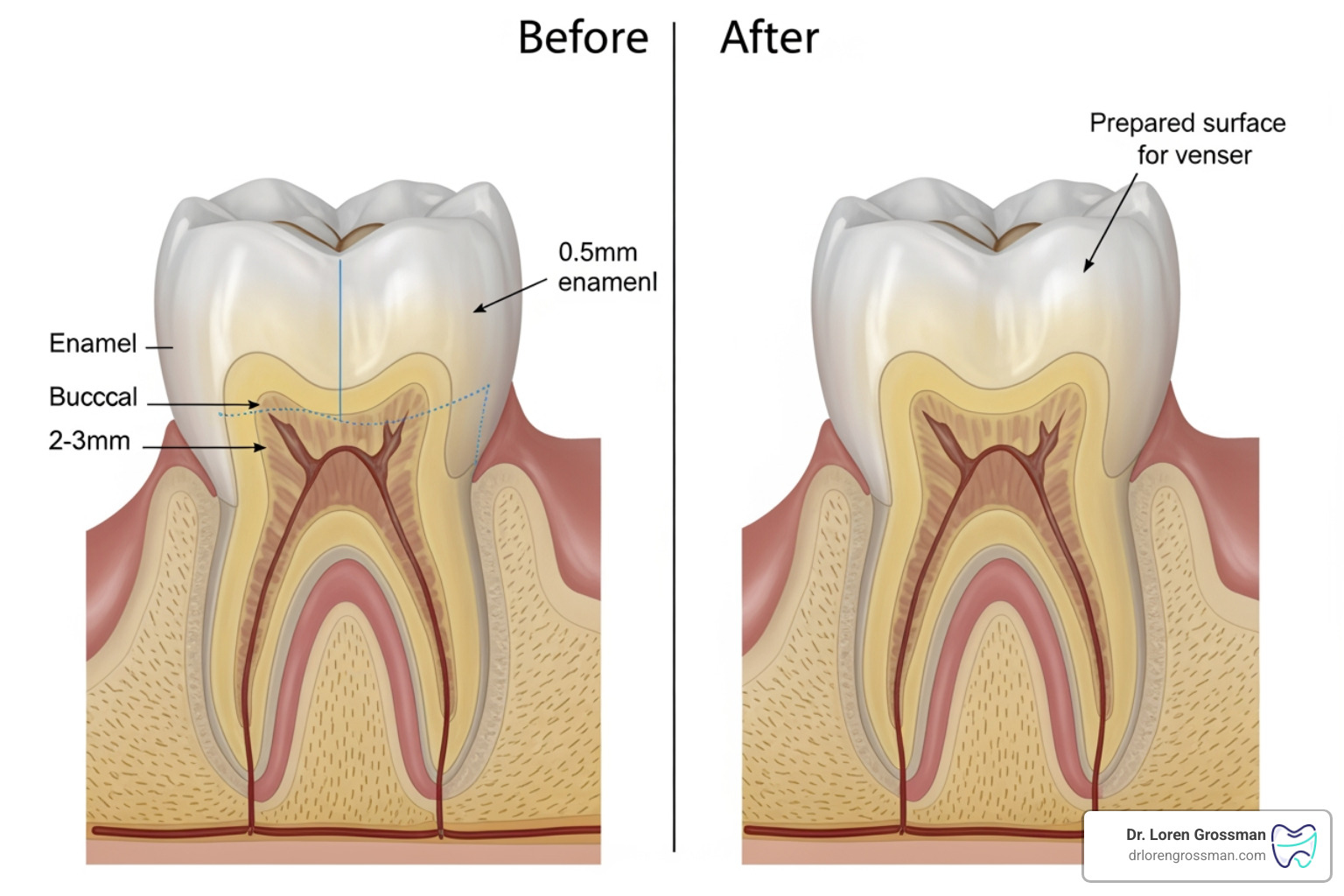 Illustration of the tooth preparation process showing 0.5mm enamel removal