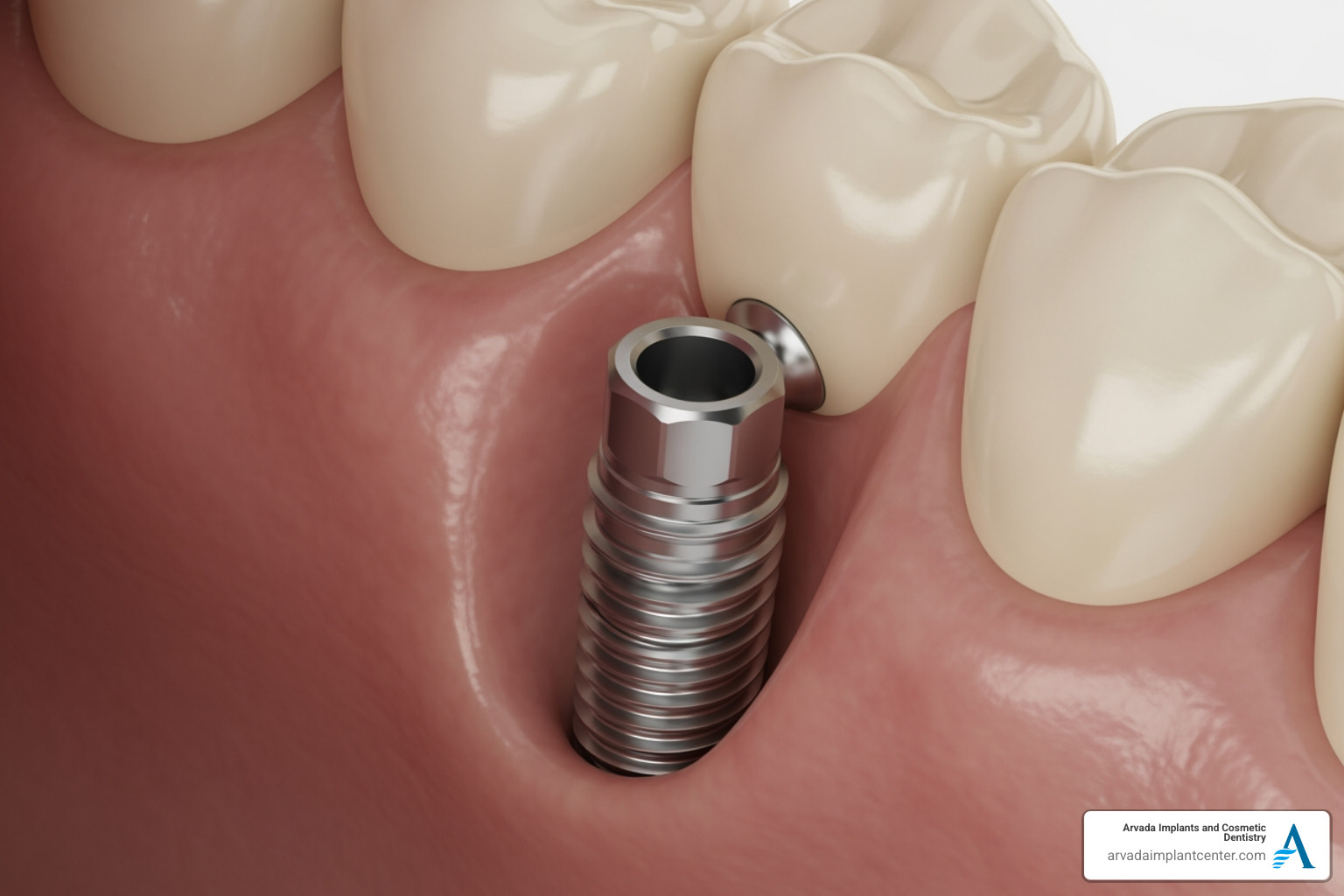 Dental implant osseointegration process showing how the titanium post fuses with the Arvada patient's jawbone