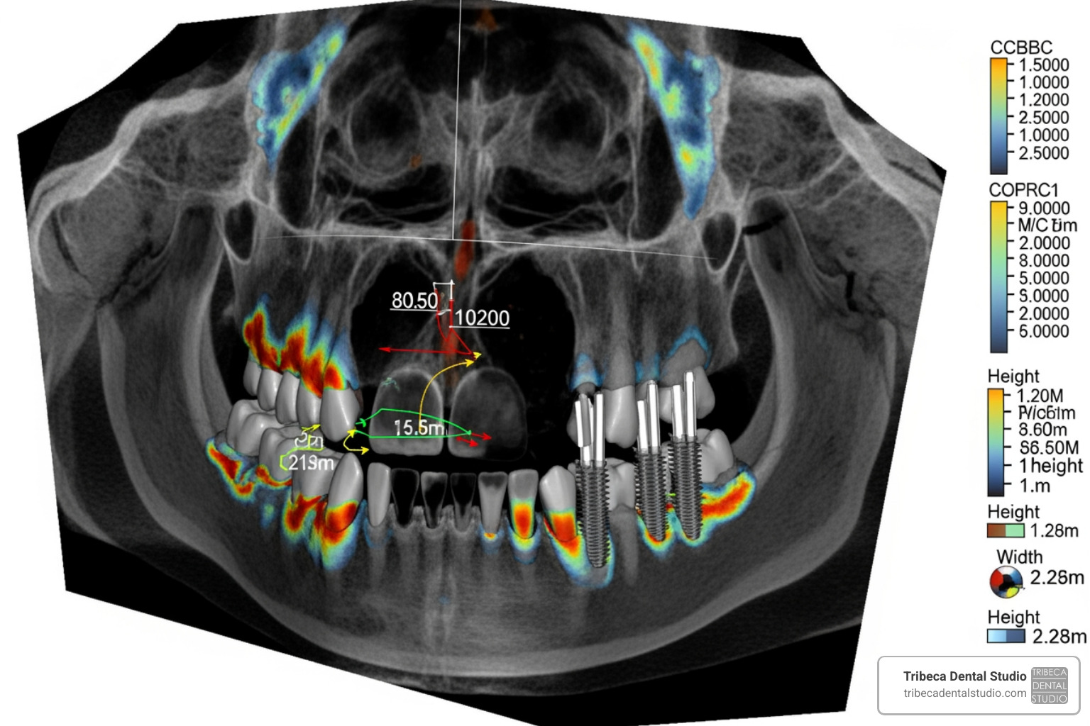 3D CBCT scan of a jawbone showing bone density and implant placement planning 3D CBCT scan of a jawbone showing bone density and implant placement planning
