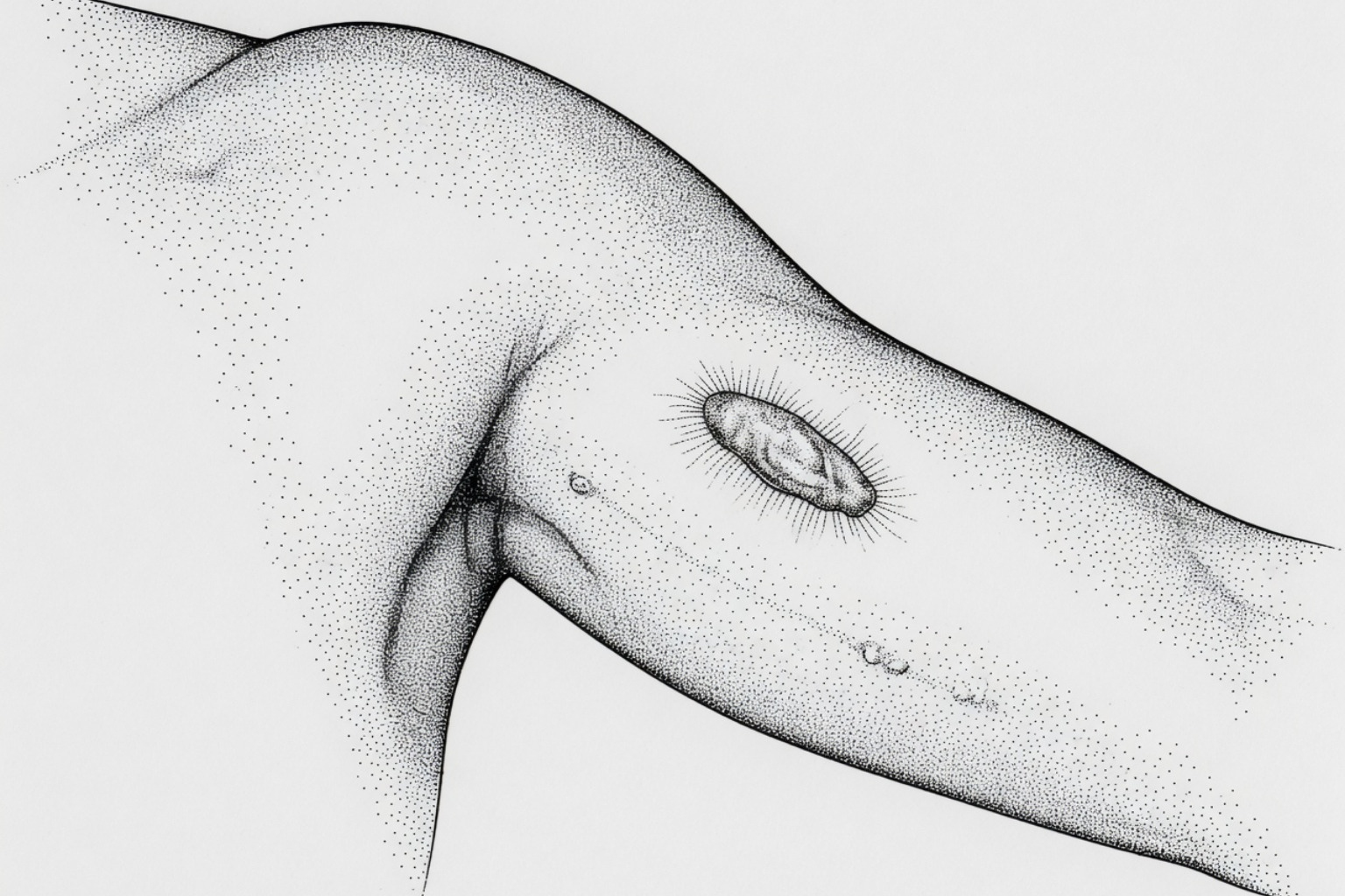 Raised keloid scar showing overgrown collagen tissue extending beyond the original wound