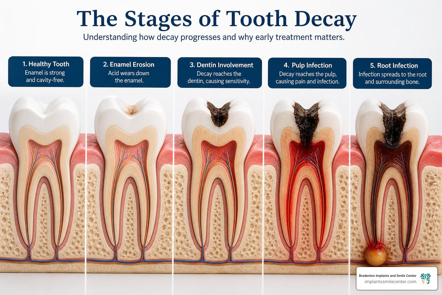 Stages of tooth decay from enamel erosion to root infection