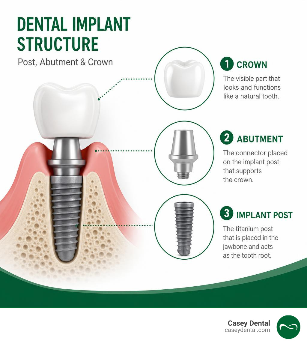 dental implant structure showing post abutment and crown infographic dental implant structure showing post abutment and crown infographic