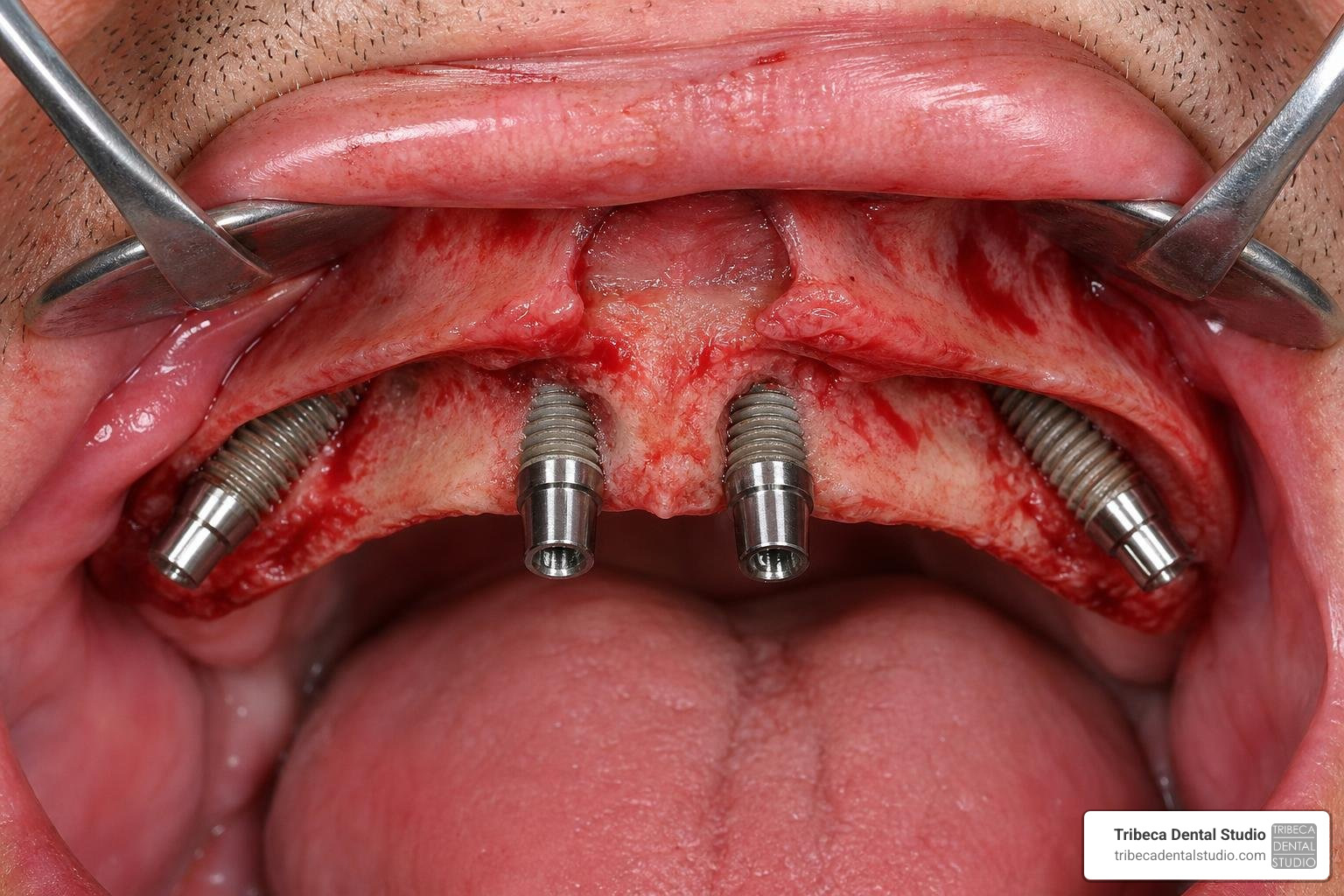 All-on-4 implant placement showing angled posterior implants All-on-4 implant placement showing angled posterior implants