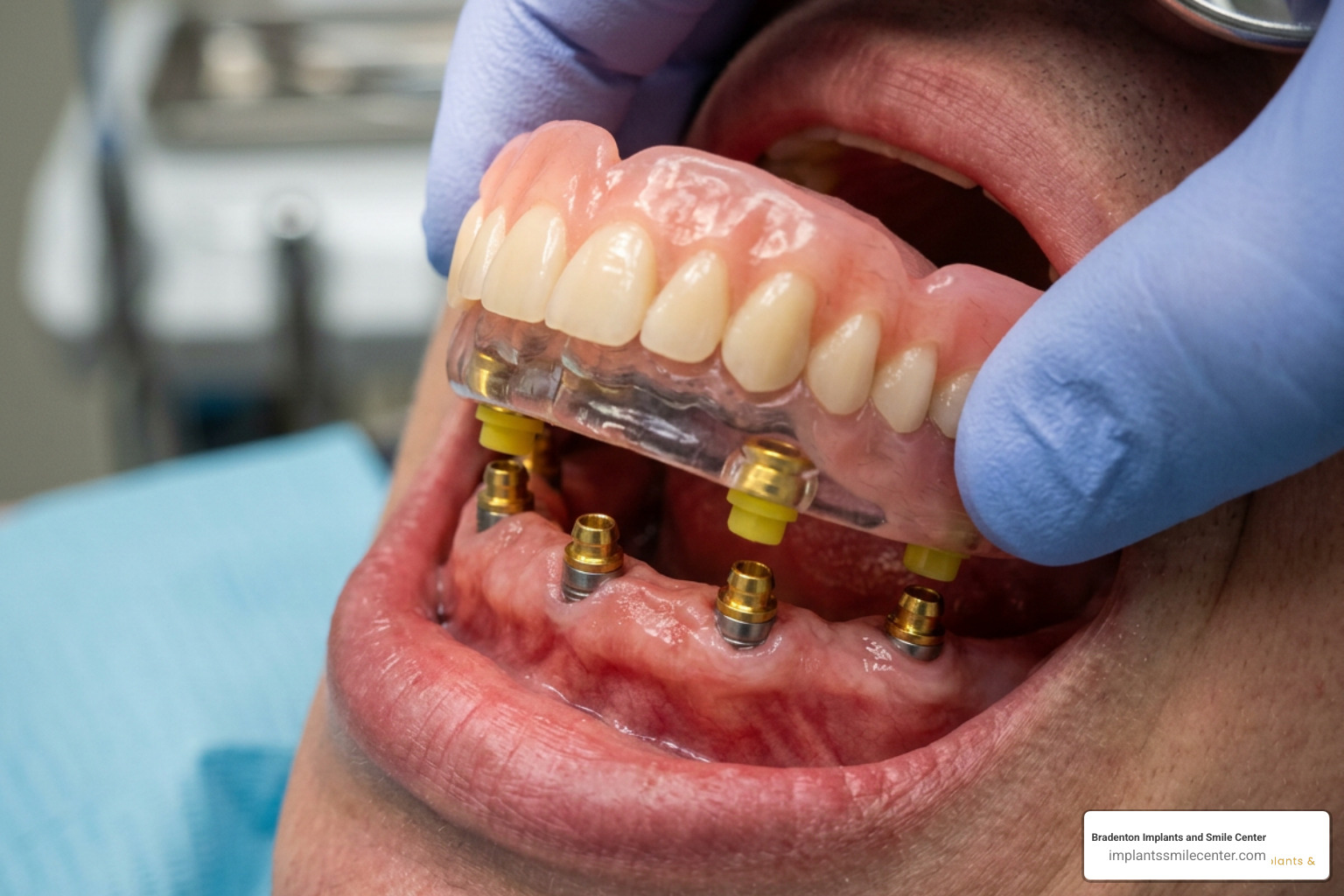 snap-on denture mechanism