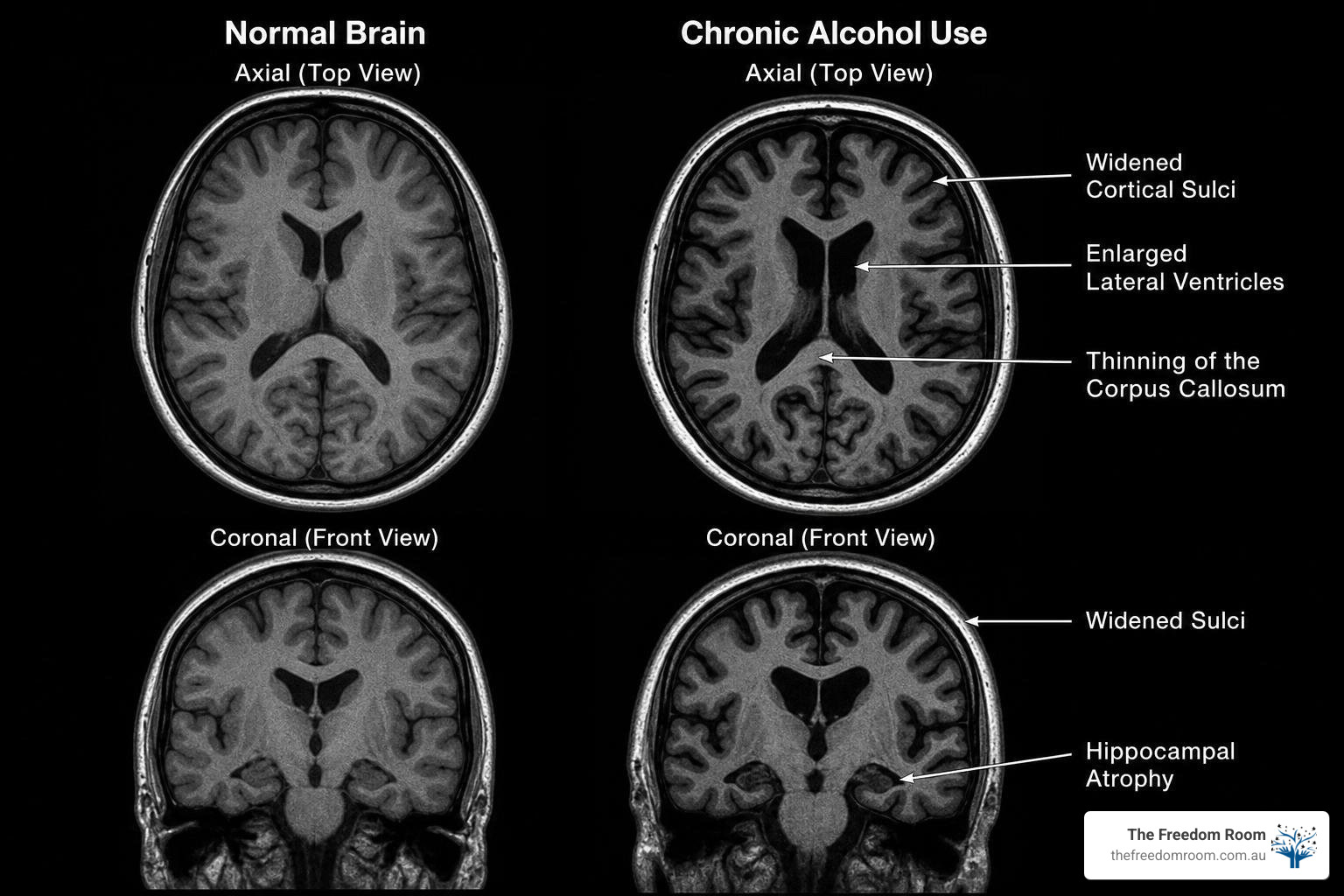 Brain scan showing volume changes and structural differences from chronic alcohol use Brain scan showing volume changes and structural differences from chronic alcohol use