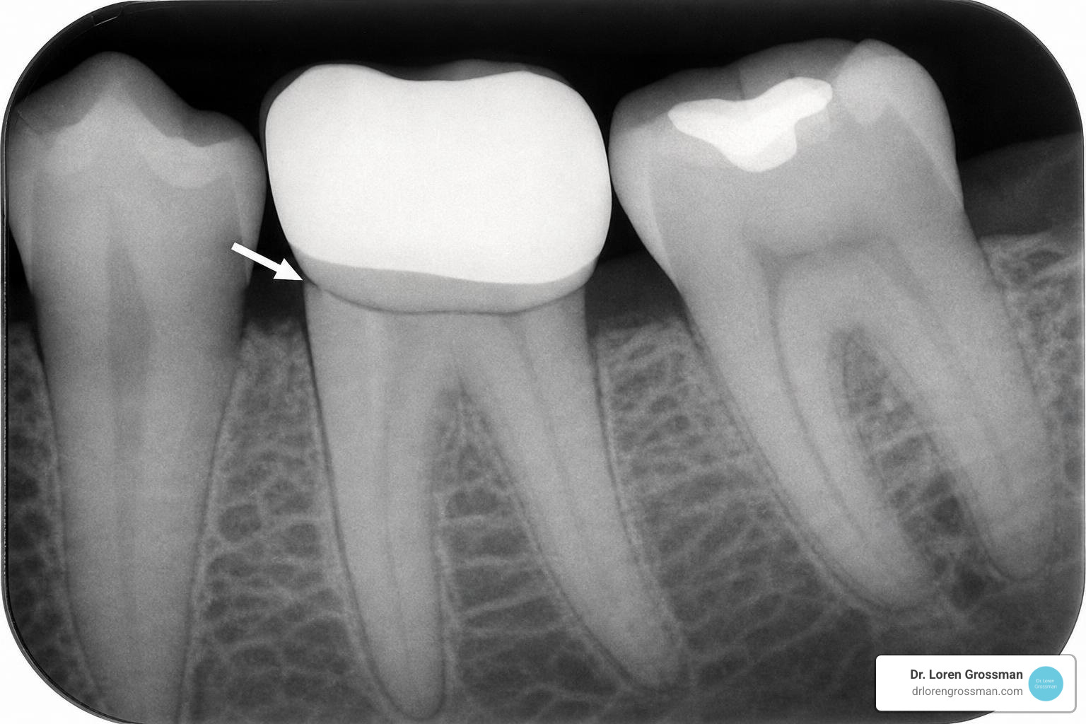 dental X-ray showing crown margin dental X-ray showing crown margin