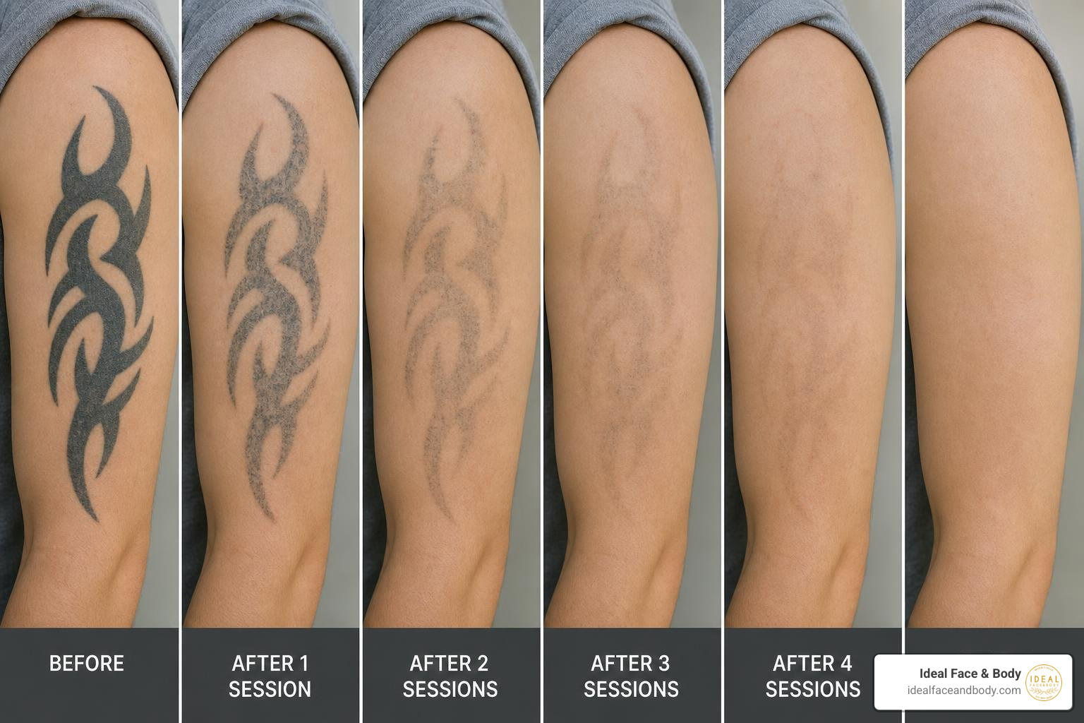 tattoo removal progress across several sessions tattoo removal progress across several sessions