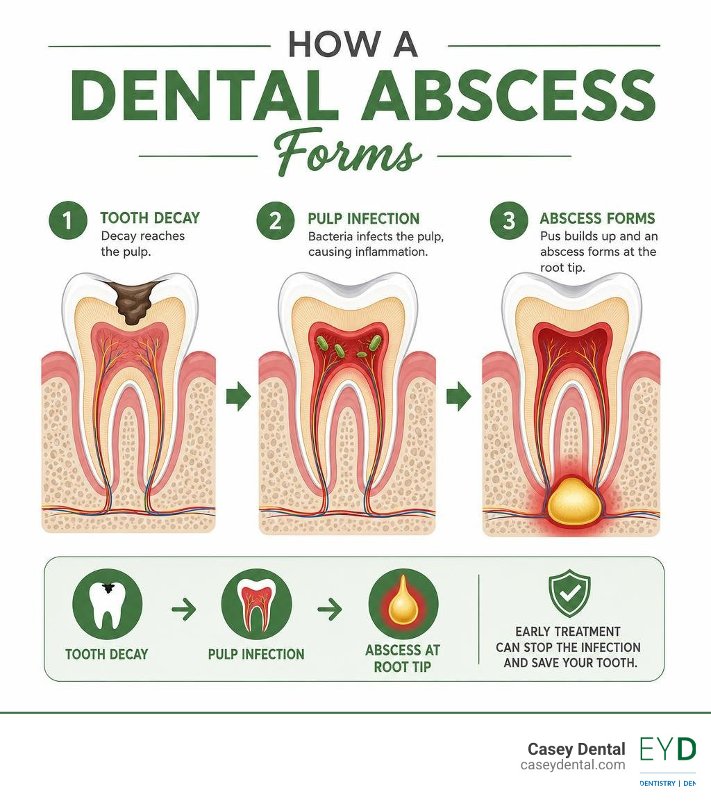 Infographic showing how a dental abscess forms: tooth decay leads to pulp infection, pus builds up, abscess forms at root