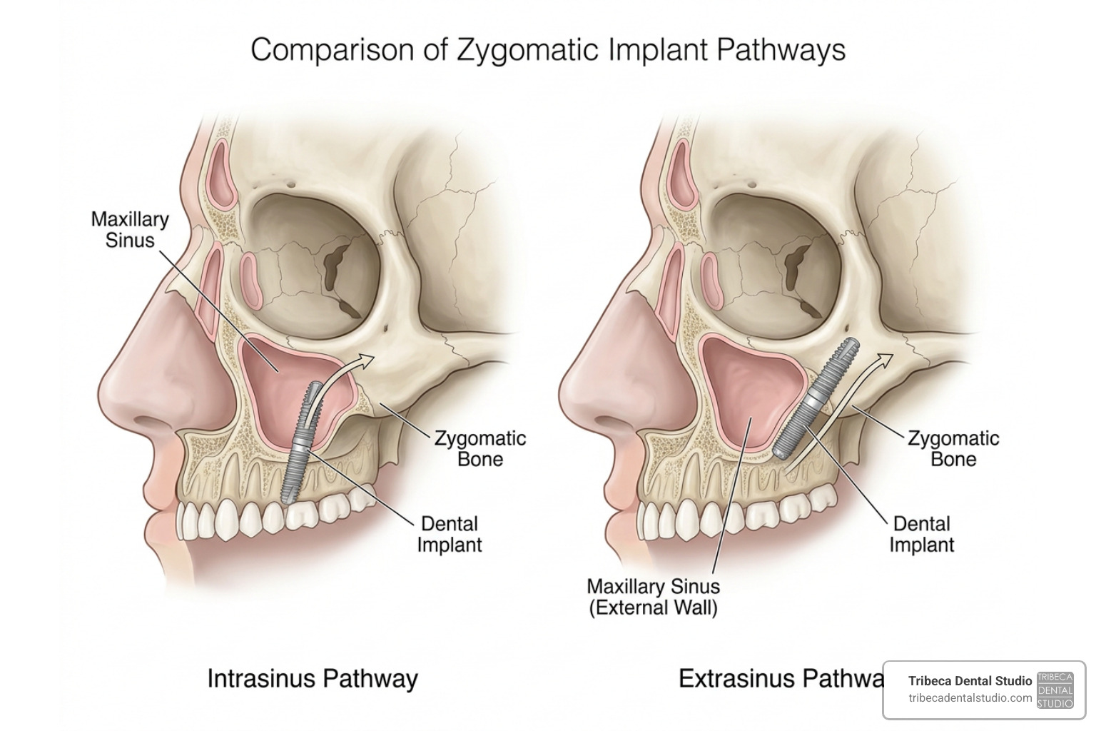 extrasinus vs intrasinus implant pathways extrasinus vs intrasinus implant pathways