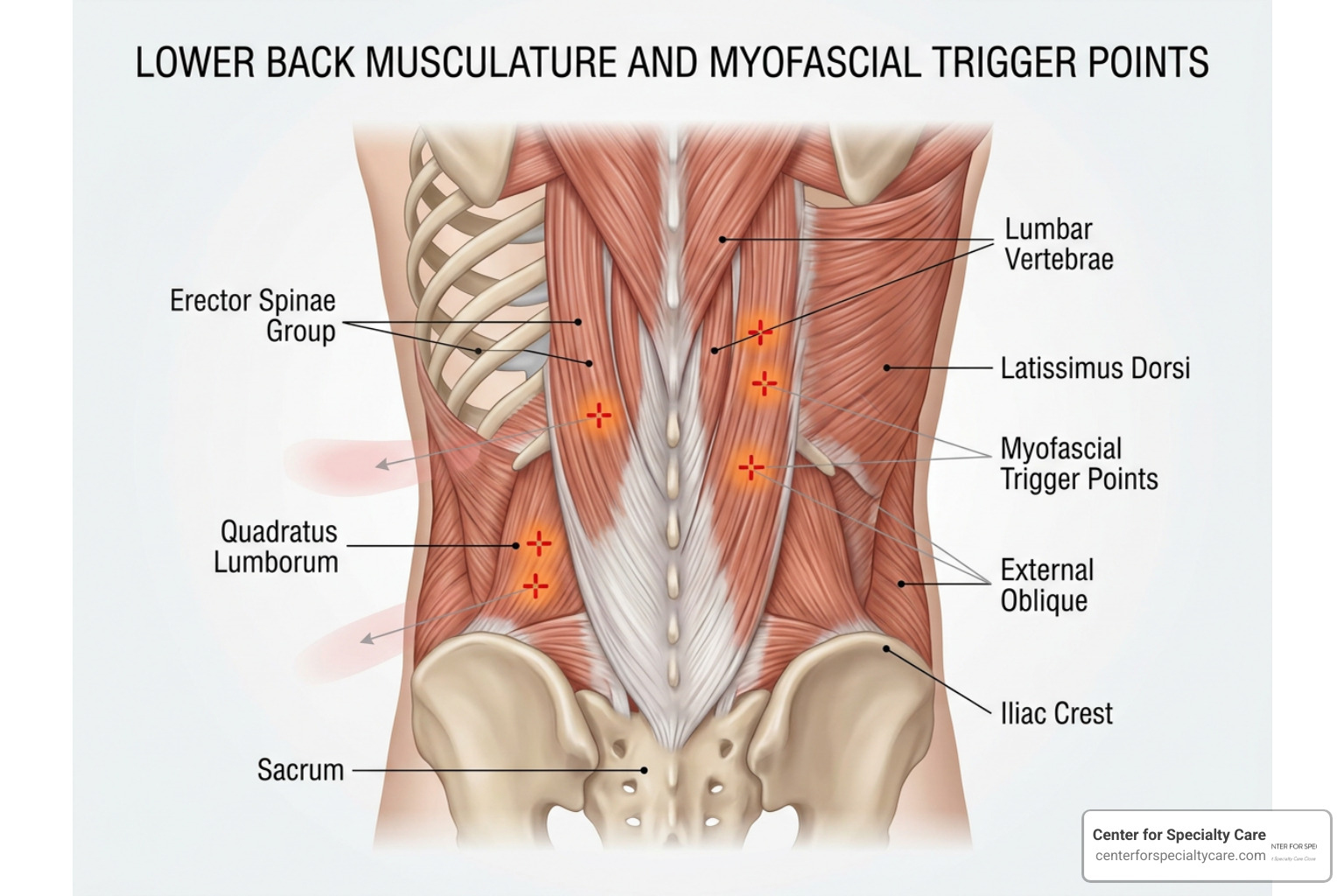 Diagram of muscle fibers and myofascial trigger points in the lower back