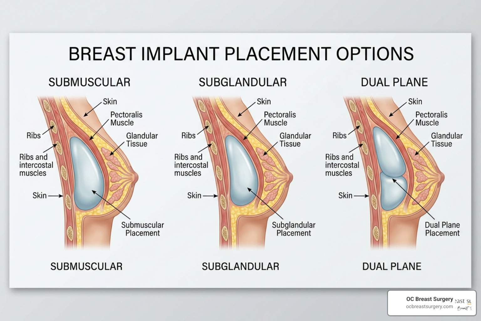 Breast implant placement options diagram