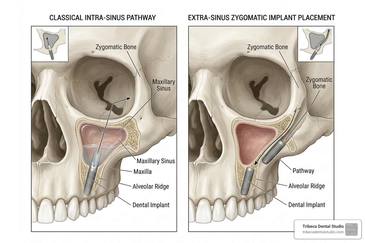 Diagram showing extra-sinus zygomatic implant placement compared to classical intra-sinus pathway Diagram showing extra-sinus zygomatic implant placement compared to classical intra-sinus pathway