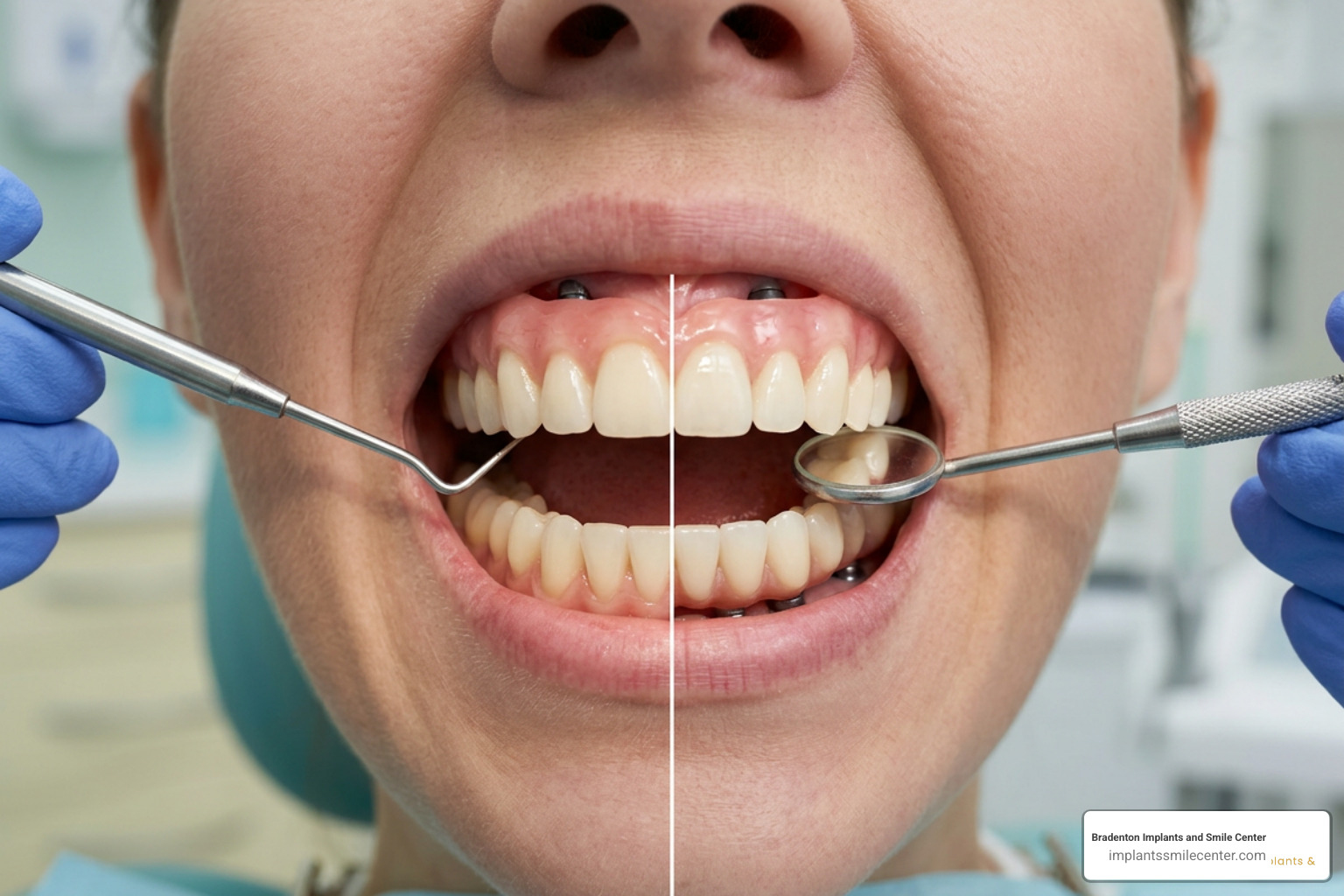 Comparison of full mouth dental implant types showing snap-in versus fixed options Comparison of full mouth dental implant types showing snap-in versus fixed options