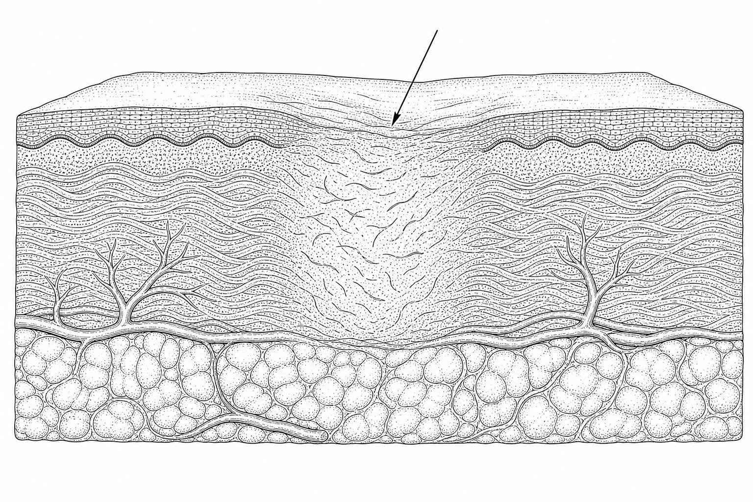 Illustration of collagen fibers remodeling within healing scar tissue