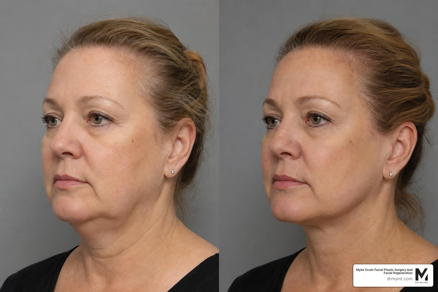 Before and after deep plane facelift results showing restored jawline and midface volume Before and after deep plane facelift results showing restored jawline and midface volume