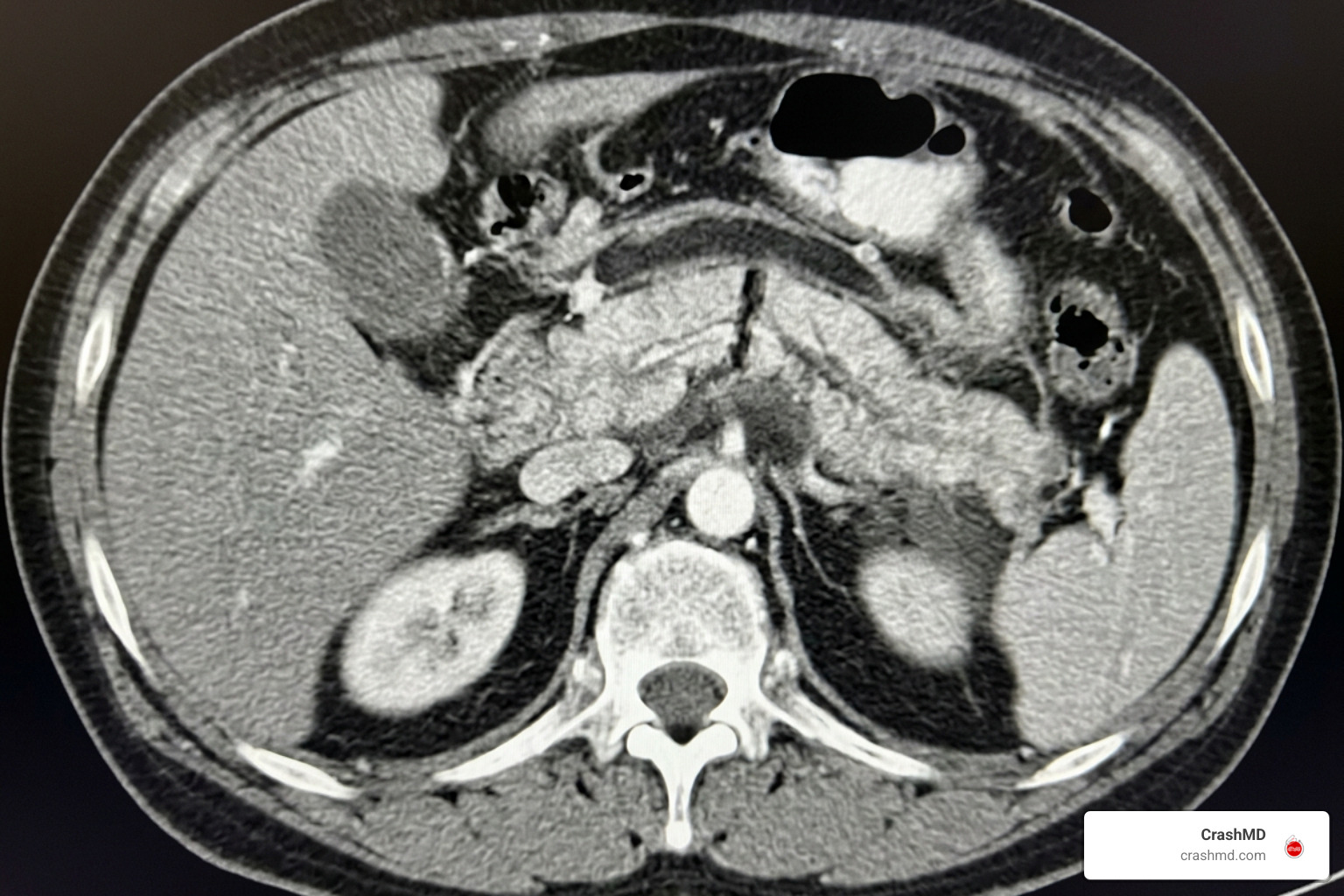 Abdominal CT scan showing pancreatic transection Abdominal CT scan showing pancreatic transection