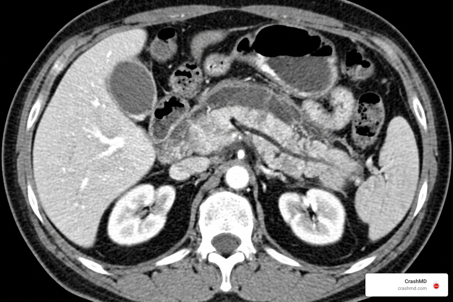 contrast CT imaging showing pancreatic laceration and peripancreatic fluid contrast CT imaging showing pancreatic laceration and peripancreatic fluid