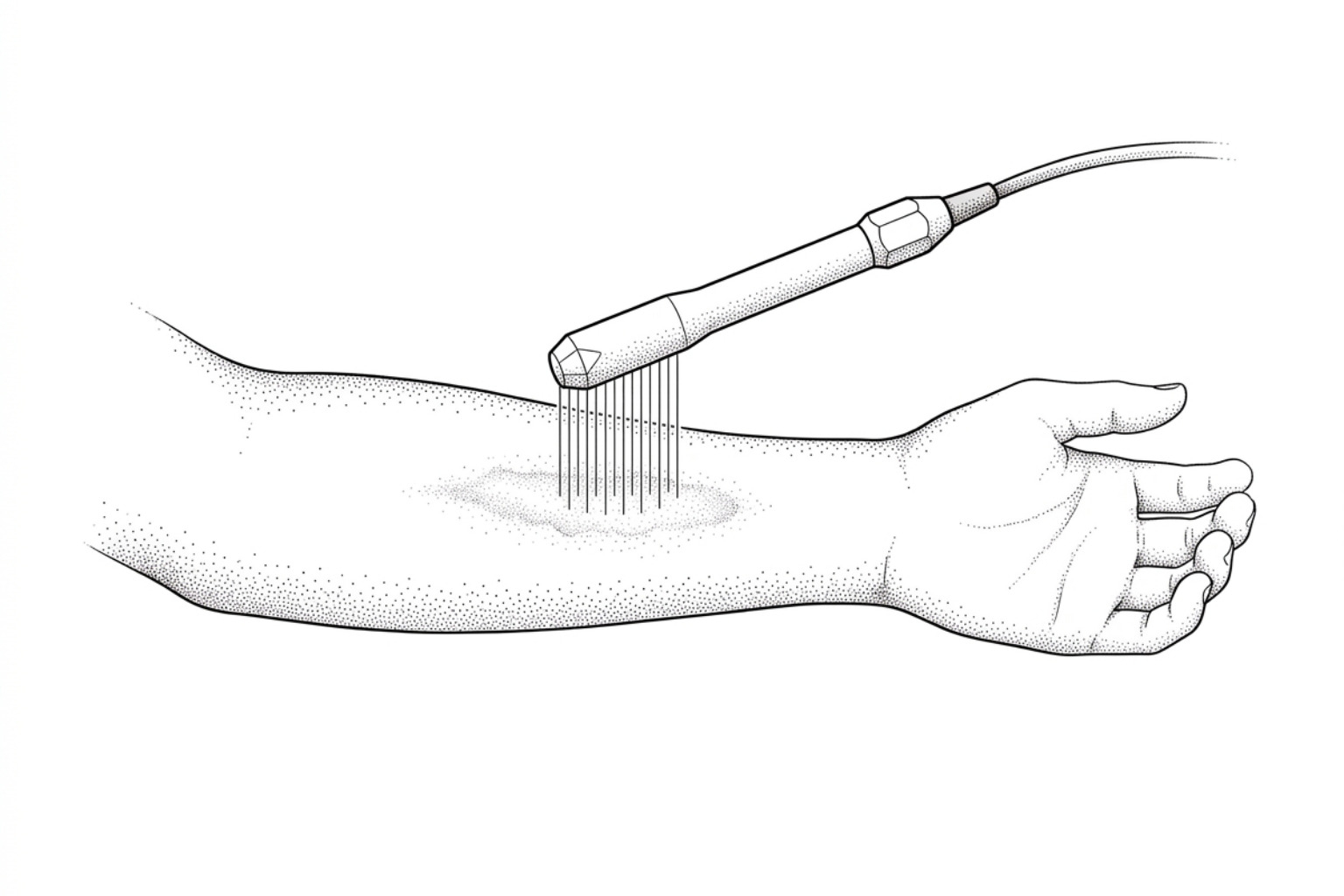 Fractional CO2 laser treatment on a hypertrophic burn scar
