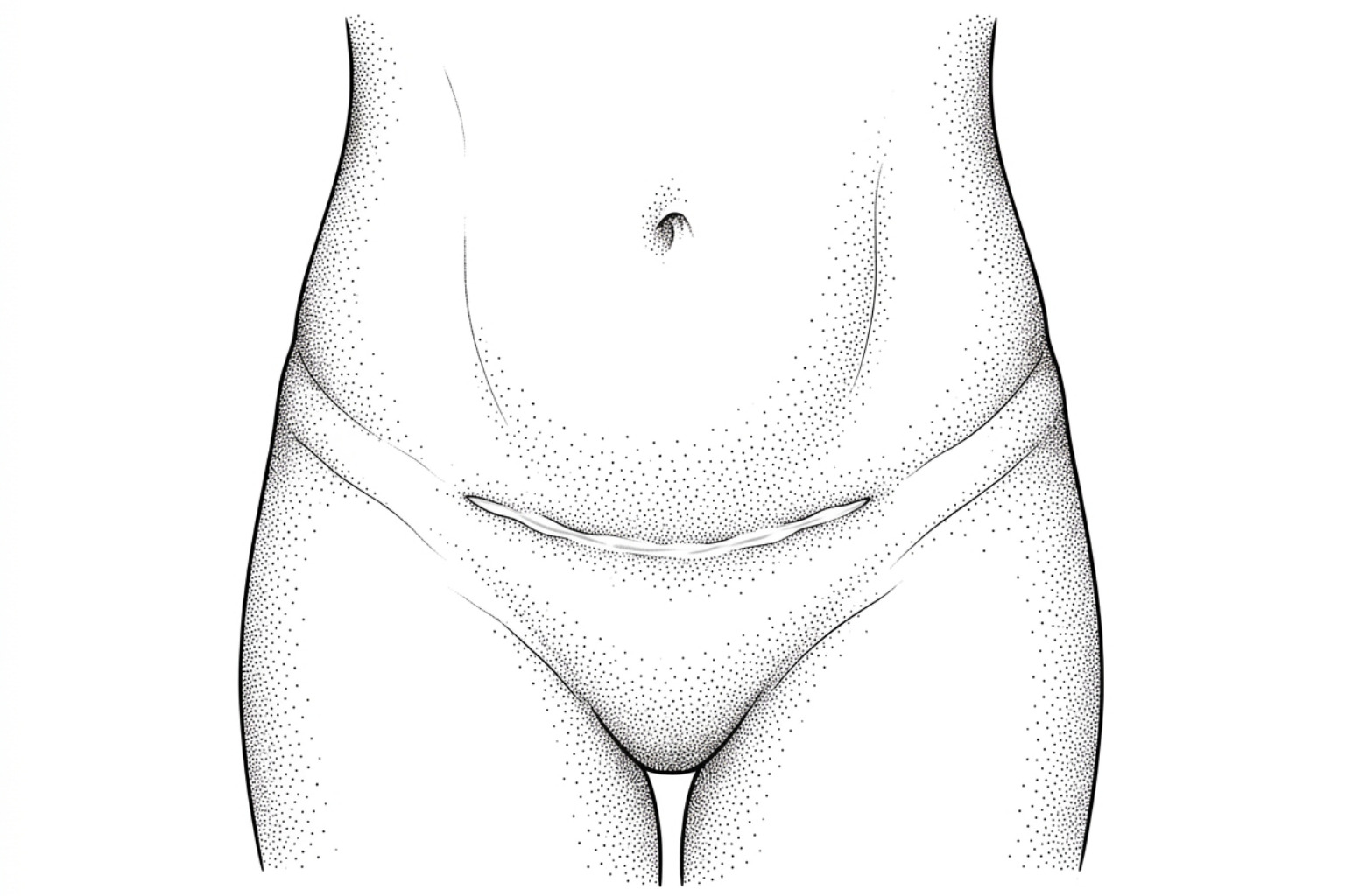 Line illustration of a lower abdomen with a horizontal C-section scar above the pubic area