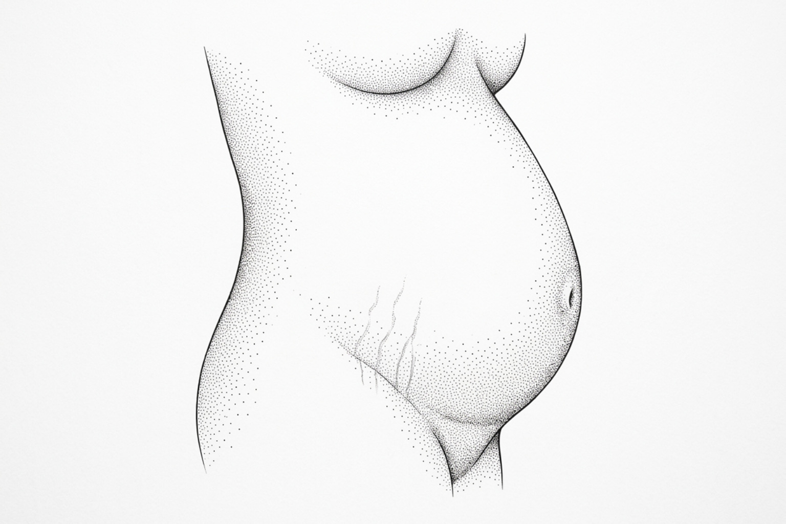 Line illustration of a pregnant abdomen in side view with faint stretch marks below the belly