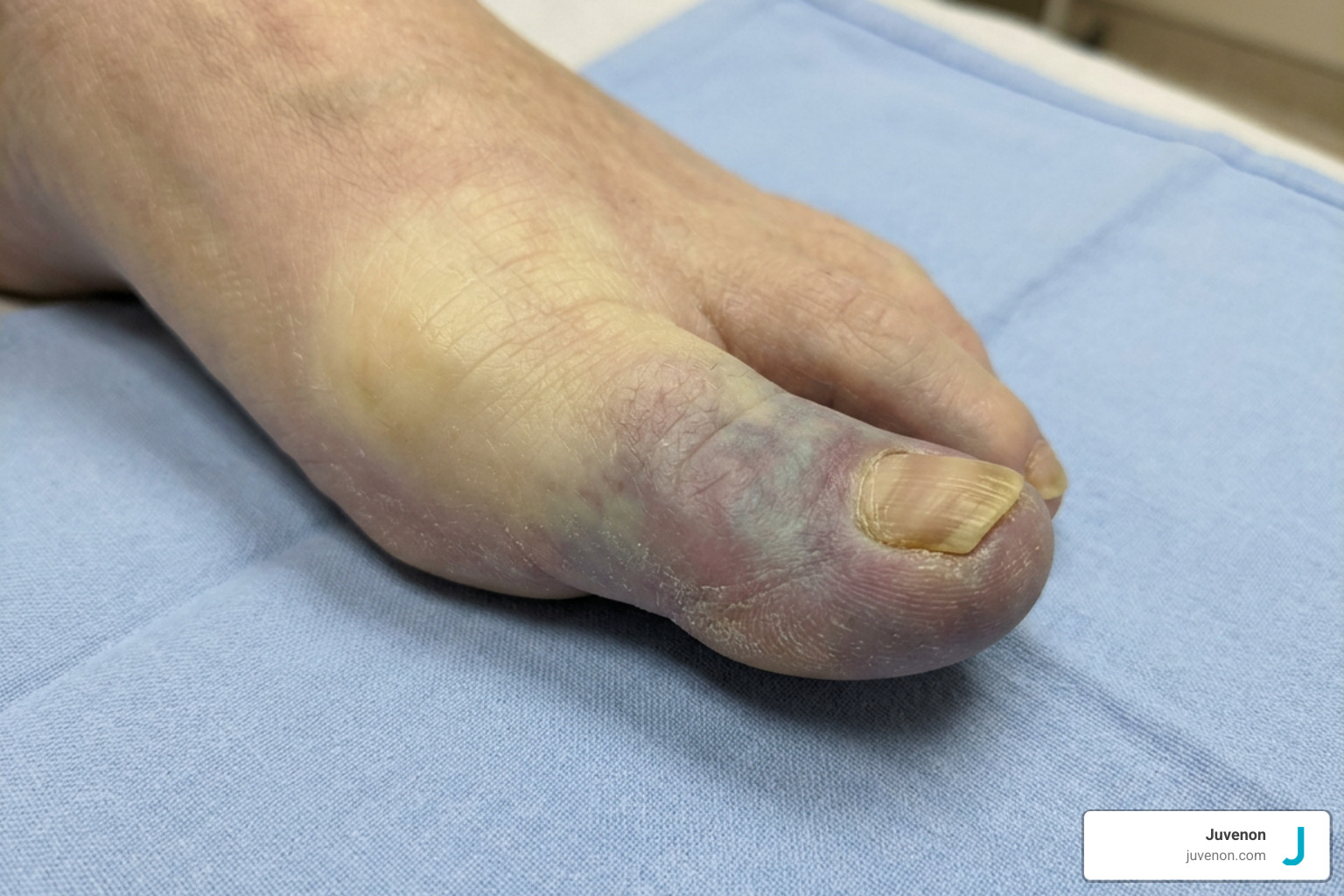 Stages of toe discoloration and vascular insufficiency
