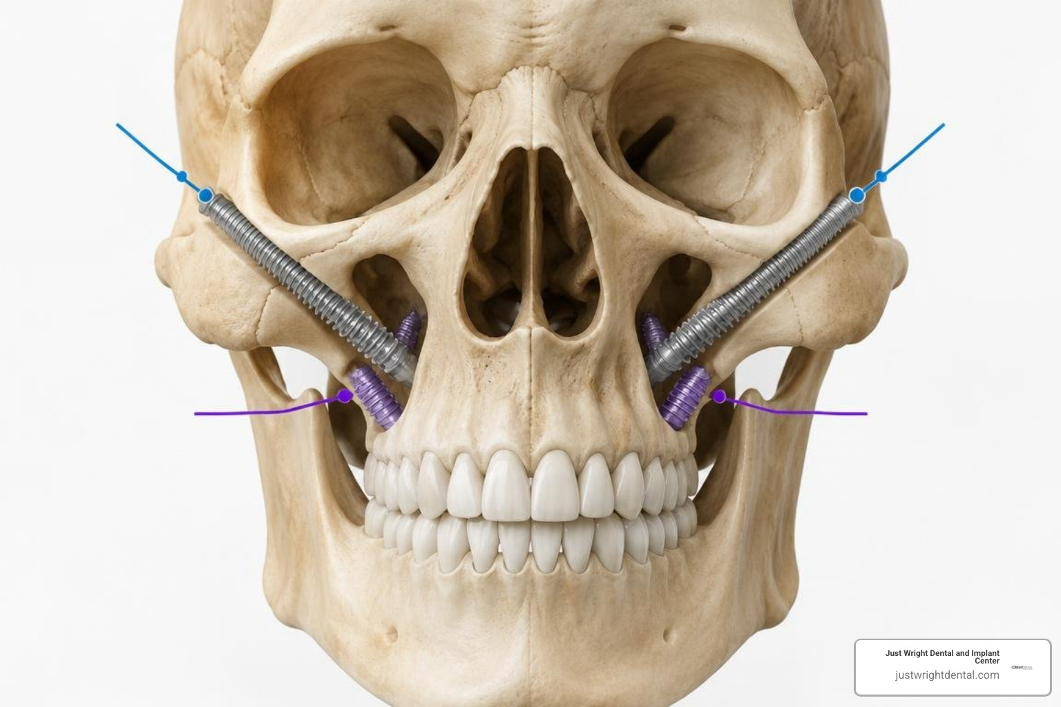 Diagram showing remote-anchorage zygomatic and pterygoid implant positions Diagram showing remote-anchorage zygomatic and pterygoid implant positions