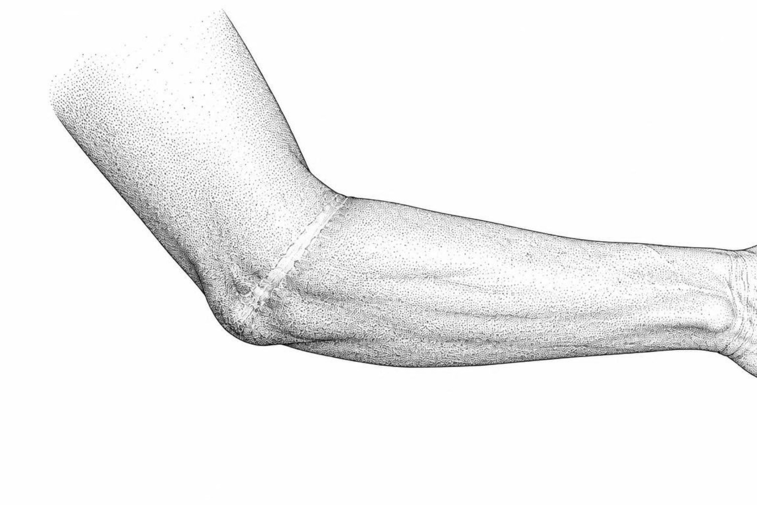 Line illustration of a forearm bent at the elbow with a ridged scar across the inner crease