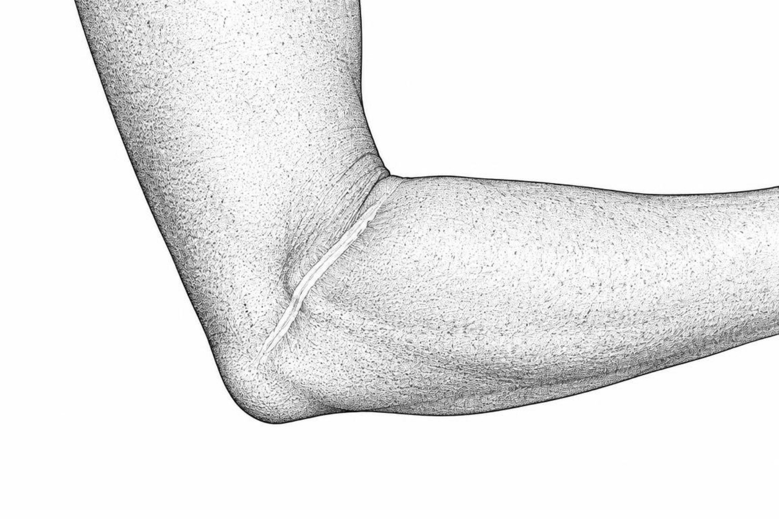 Line illustration of a bent elbow with a raised scar across the inner crease pulling the skin tight
