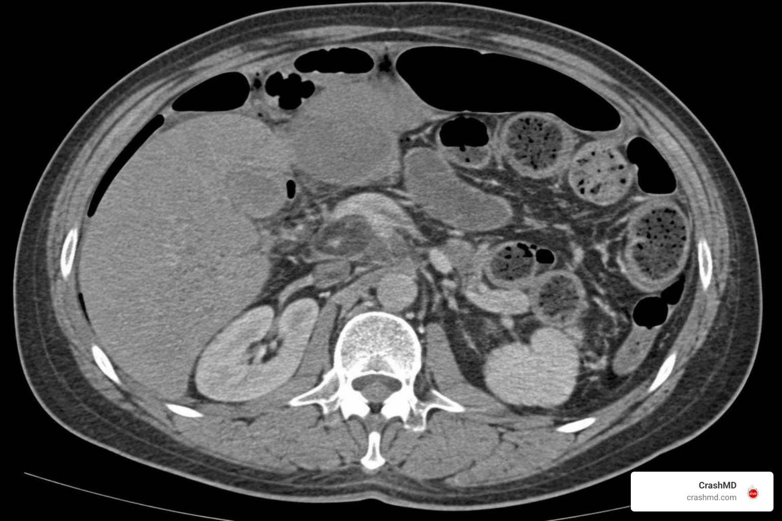 abdominal CT scan showing pneumoperitoneum free air abdominal CT scan showing pneumoperitoneum free air