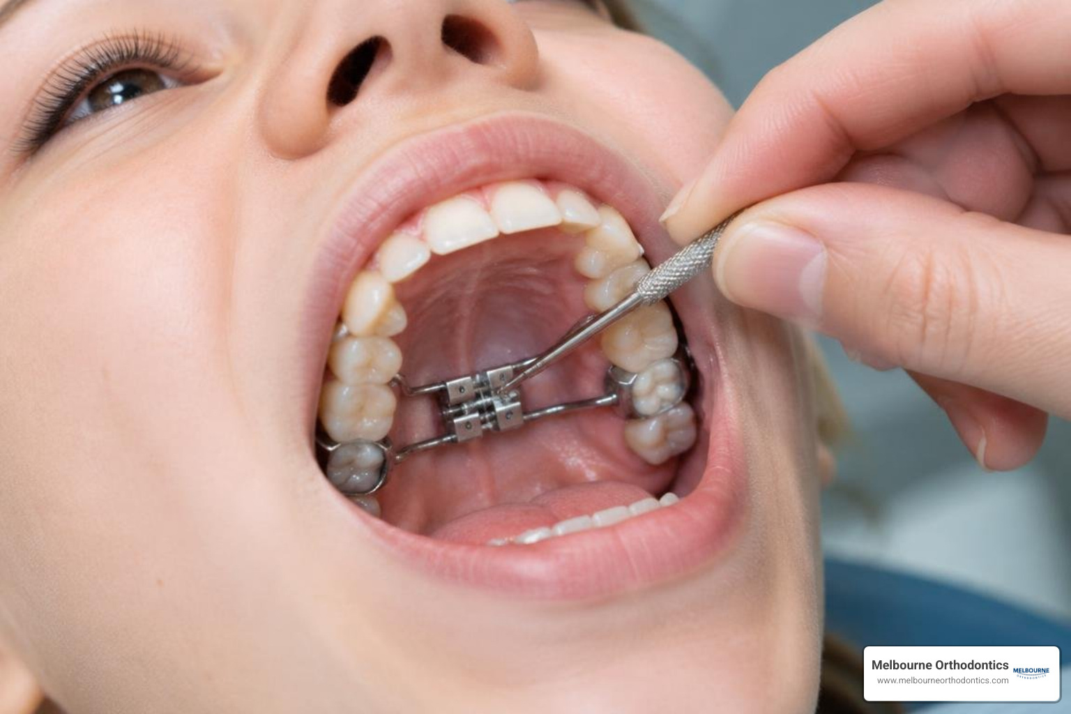Hand using an expander key mechanism to activate a palatal expansion appliance