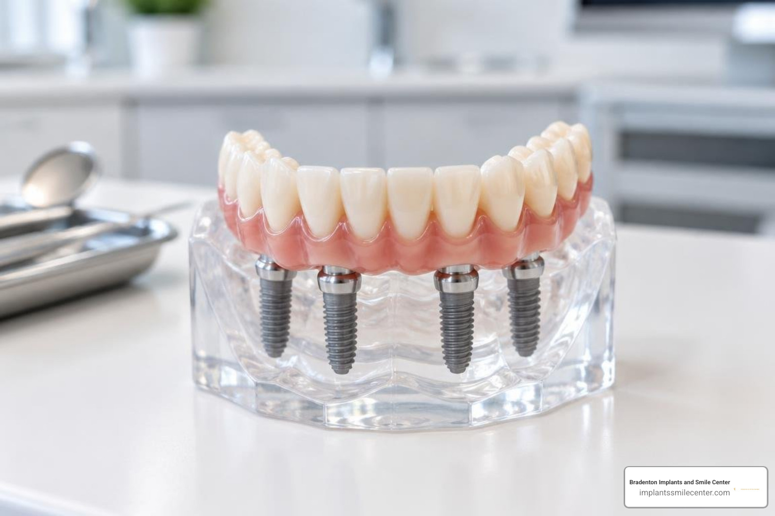 full arch implant prosthetics